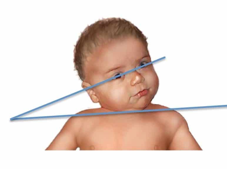 Baby Torticollis Treatment in Damansara Heights, Kuala Lumpur Malaysia